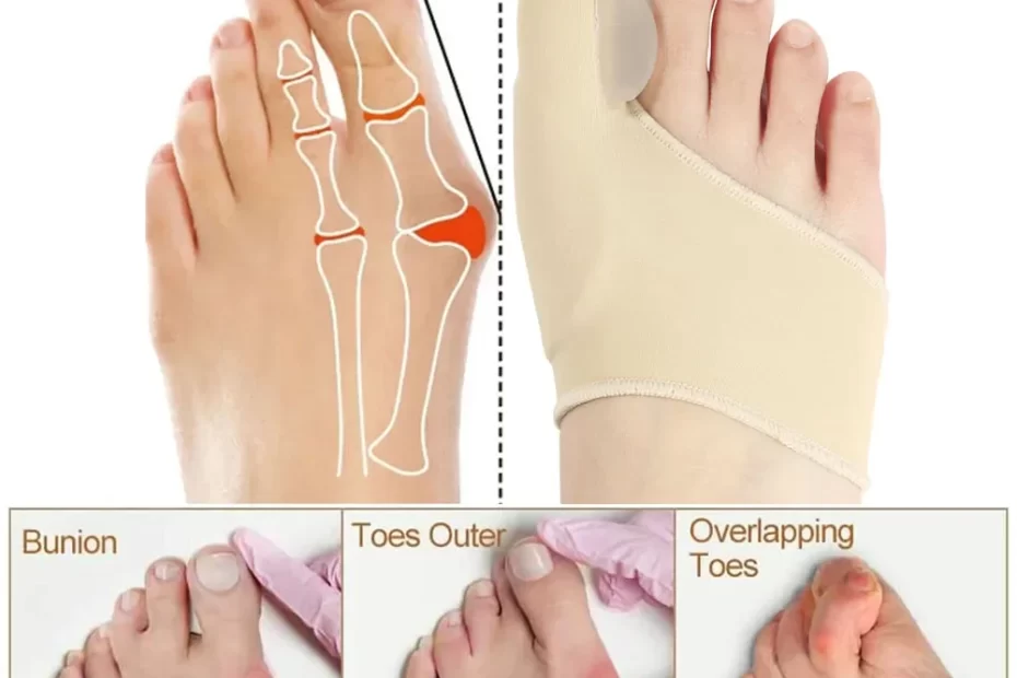 benefits of bunion corrector