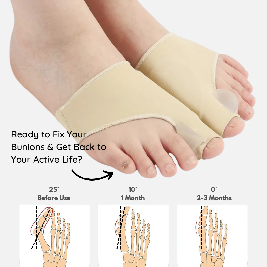 correct bunion